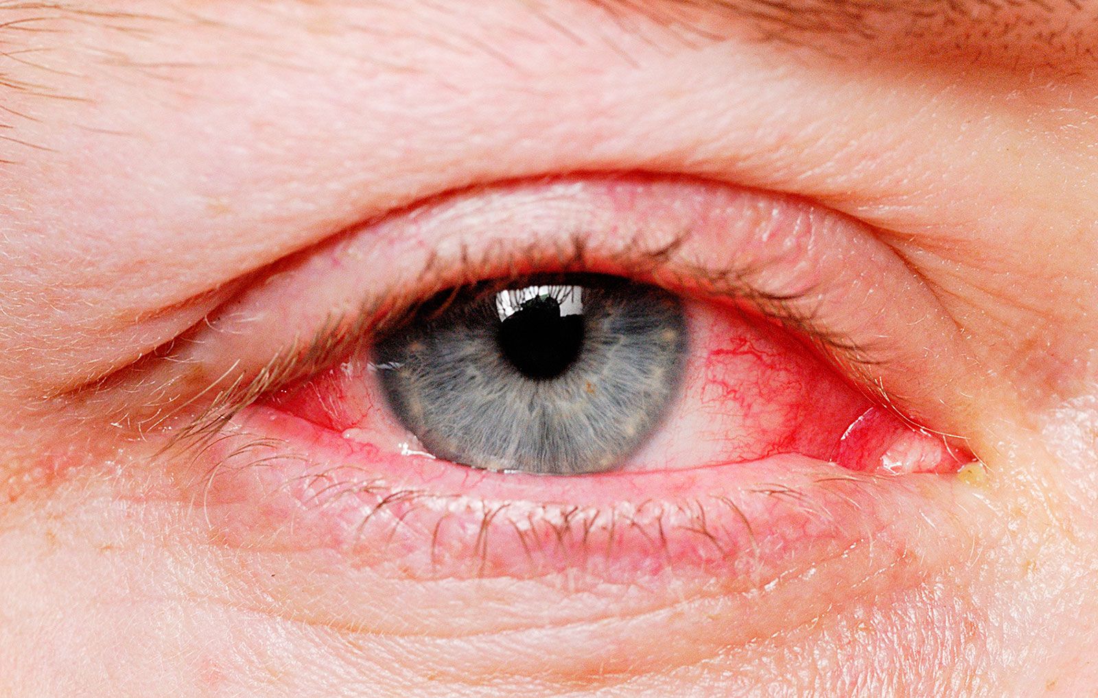 Easy Hacks to Deal and Heal Common Eye Infections