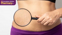 Stretch Marks: Causes and Natural Home Remedies